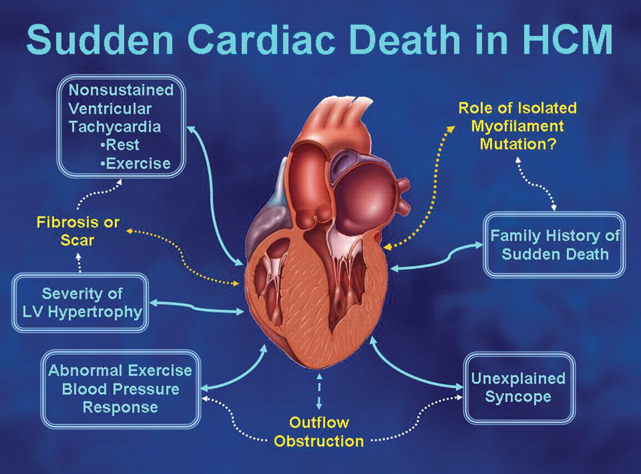 Is sudden cardiac death painful image