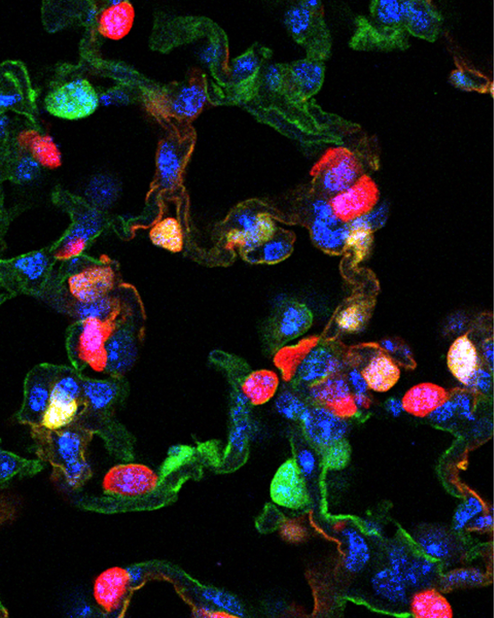 New research explains how immune cells called macrophages in the lung sometimes stick around too long, even after clearing a viral infection, leading to long-term lung problems.