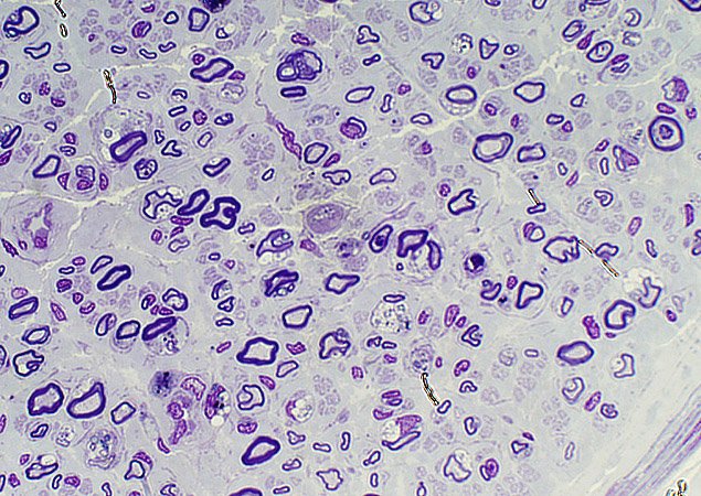 Researchers find a gene associated with one form of leukodystrophy, a group of orphan diseases attacking the neurological system. Researchers find a gene associated with one form of leukodystrophy, a group of orphan diseases attacking the neurological system.