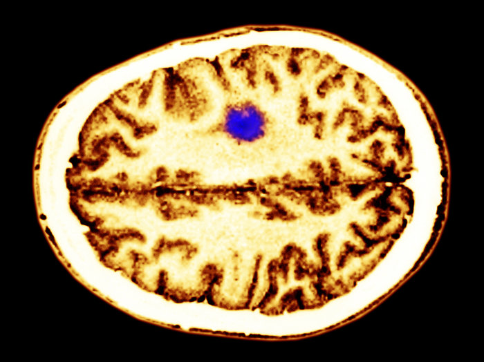 A color-enhanced cerebral MRI showing a glioma tumor