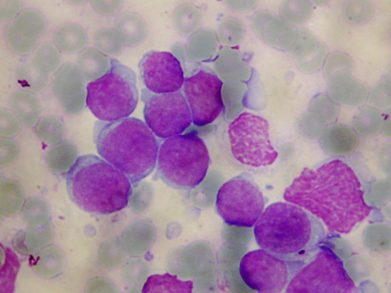 new-t-cell-leukemia-treatment-target-identified-immunology