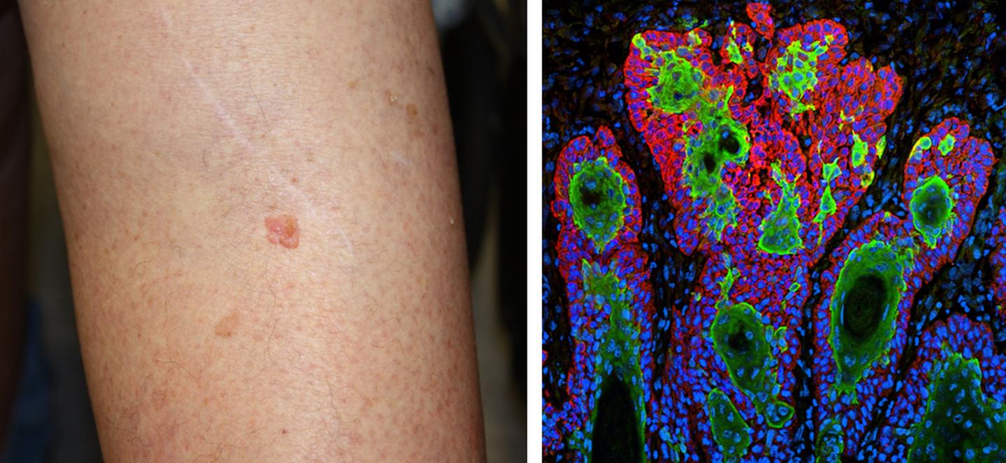 a call to reduce mohs skin cancer surgery: doctors respond to