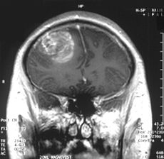 Glioblastoma in 15 year old patient.