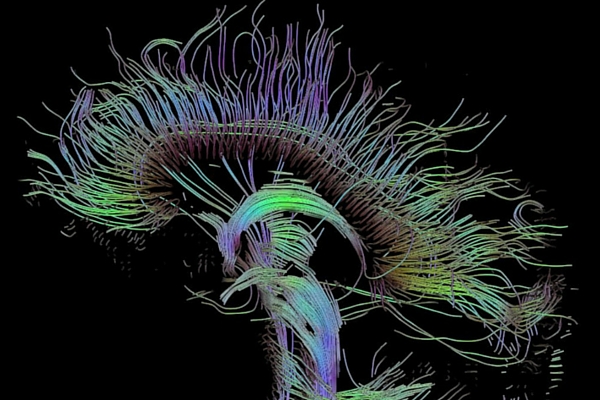 A certain kind of high tech MRI can see brain structures better