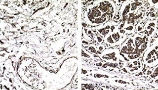 Samples from non-metastatic (left) and metastatic breast cancer (right) cells showing enhanced expression of a specific gene in metastatic tumors because those cells have increased levels of a tRNA called GluUUC.
