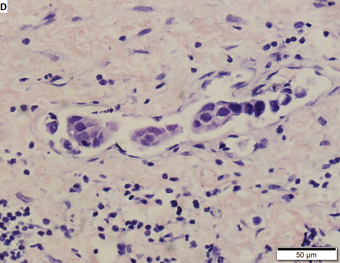 To Treat Bladder Cancer, You Need Immune Cells | Cancer