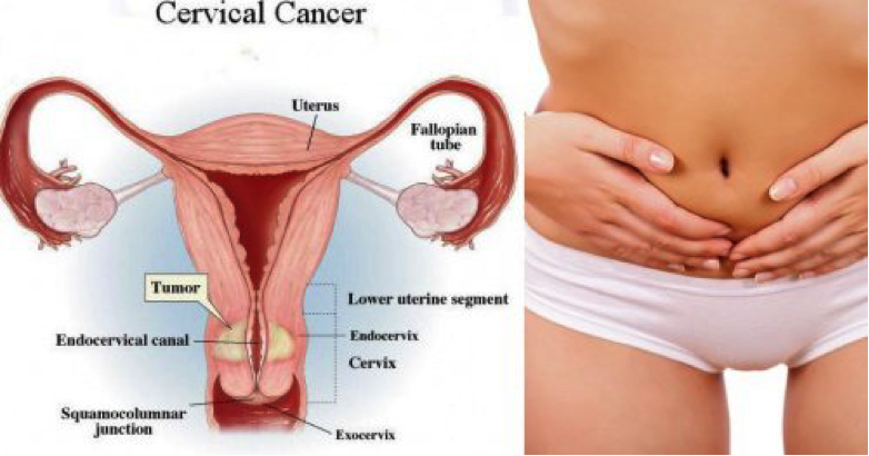 Protein discovery could lead to new drug targets for cervical cancer