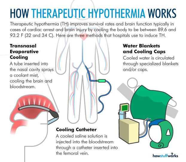 Therapeutic Hypothermia Saves Cardiac Arrest Patients Cardiology