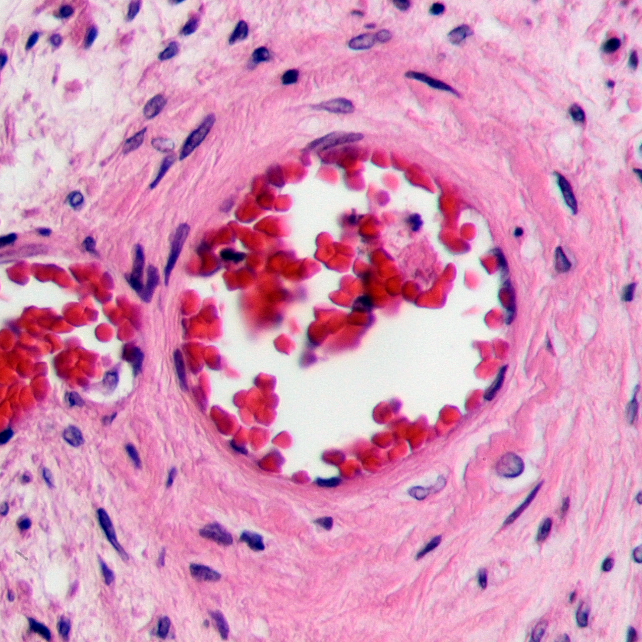 thrombotic thrombocytopenic purpura