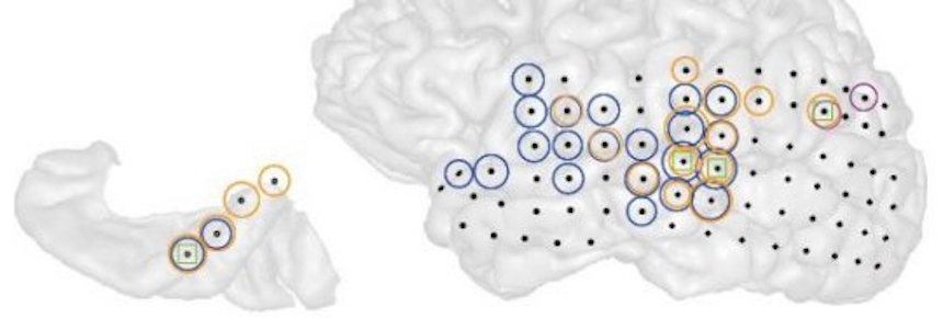 3-D image of the left hemisphere of a patient with tinnitus (right). Black dots indicate all the sites recorded from. Colored circles indicate electrodes at which the strength of ongoing brain activity correlated with the current strength of tinnitus perceived by the patient. Different colors indicate different frequencies of brain activity (blue = low, magenta = middle, orange = high). 3-D image of the left hemisphere of a patient with tinnitus (right). Black dots indicate all the sites recorded from. Colored circles indicate electrodes at which the strength of ongoing brain activity correlated with the current strength of tinnitus perceived by the patient. Different colors indicate different frequencies of brain activity (blue = low, magenta = middle, orange = high).