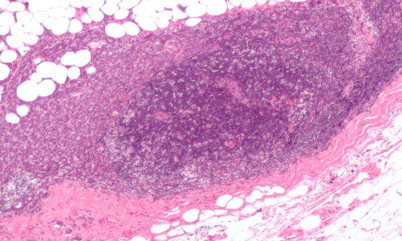 This micrograph shows a lymph node invaded by ductal breast carcinoma, with an extension of the tumor beyond the lymph node. This micrograph shows a lymph node invaded by ductal breast carcinoma, with an extension of the tumor beyond the lymph node.
